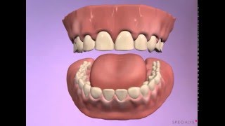 Prothèse adjointe complète maxillaire [upl. by Gaye]