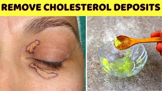 Remove cholesterol deposits xanthelasma around eyes naturally at home [upl. by Narib204]