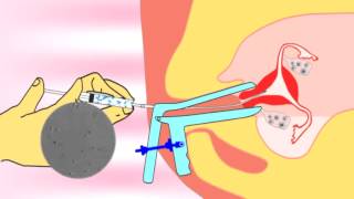 Intrauterine insemination IUI videoflv about infertility and ivf treatment [upl. by Grier]