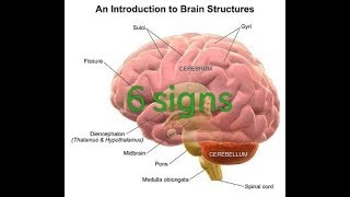 6 signs or symptoms of cerebral edema [upl. by Rahs]