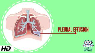 Pleural Effusion Causes Signs and Symptoms Diagnosis and Treatment [upl. by Glover]