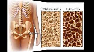 Bone remodeling Bob and Claude [upl. by Gerstein]