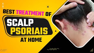 Scalp Psoriasis Removal Home Remedies  Best Treatment Of Scalp Psoriais At Home  Dr Health [upl. by Baer]