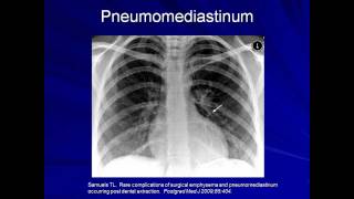 Lung Protective Ventilation Mechanical Ventilation  Lecture 9 [upl. by Eimot822]