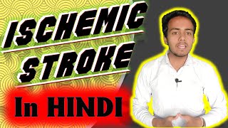 Ischemic Stroke इस्कीमिक स्ट्रोक ब्रेन स्ट्रोक Detailed In Hindi By SahilMittal MEP [upl. by Nyvar]