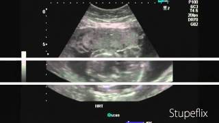 EIF or echogenic intracardiac focus Ultrasound video [upl. by Seuqram]