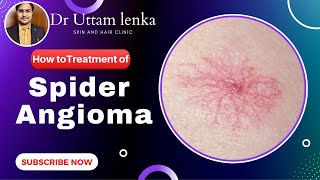 Spider Angioma cause and Treatment radiating blood vessels on skin  Dr Uttam Kumar Lenka [upl. by Miner]