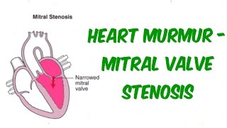 Mitral Stenosis  Auscultation Sound [upl. by Araid]