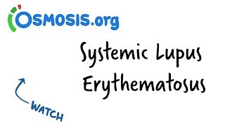 Systemic Lupus Erythematosus  Clinical Presentation [upl. by Joy484]