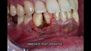 Oral Pyogenic Granuloma Treatment in Bangalore  Dental Solutions Bangalore [upl. by Assilam685]