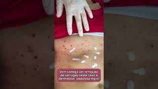 Vem ver remoção de dermatose papulosa nigra comigo [upl. by Lapham]