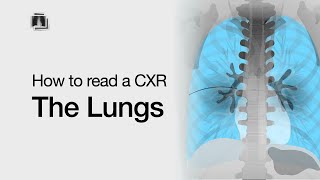 How to Read a Chest XRay The Lungs [upl. by Enitsrik]