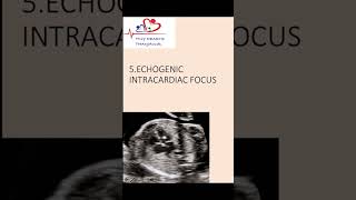 Echogenic intracardiac focus on antenatal scanwhat does it mean echogenicfocus heart [upl. by Volotta]