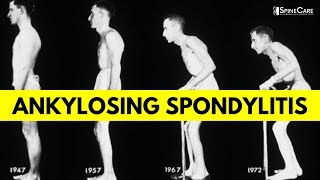 What is Ankylosing Spondylitis Causes Symptoms and Diagnosis EXPLAINED [upl. by Swetiana]