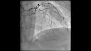 Left coronary angiogram RAO cranial [upl. by Anul]