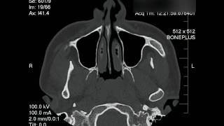 Deviated Septum Nasal CAT scan Slow Motion [upl. by Itoc]