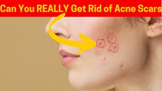 Can You REALLY Get Rid of Acne Scars in 2 Ways [upl. by Ileak]