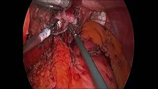 Awais Roux en Y jejunum for esophageal reconstruction [upl. by Mat674]