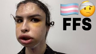 Facial Feminization Surgery  Tyler Brown [upl. by Eudoca]