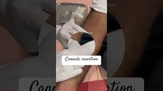 Cannula insertion of male patient Nurses cannulaDoctor neetnursingstudentsshortsyoutubeshorts [upl. by Lias879]