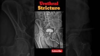 Retrograde urethrogram rgu urethralstricture shorts radiologicalprocedure radiology [upl. by Htebarual]