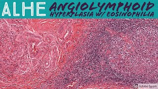 ALHE Angiolymphoid Hyperplasia with Eosinophilia 5Minute Pathology Pearls [upl. by Yong778]