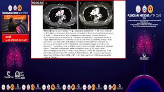 HIGH RISK PULMONARY EMBOLISM [upl. by Aneeuqal]