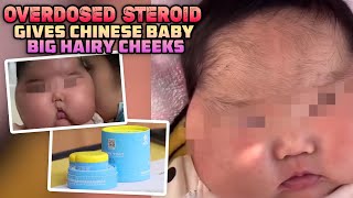 MASSIVELY OVERDOSED Steroid Gives Chinese Baby Big Hairy Cheeks  Science Explained [upl. by Fitzpatrick]