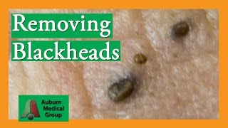 Several Blackheads  Auburn Medical Group [upl. by Leotie]