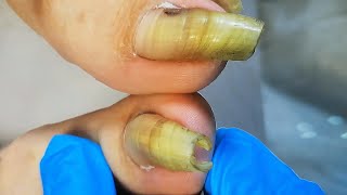 Trim extra long toenail like cicada chrysalis  Satisfying video [upl. by Sella]