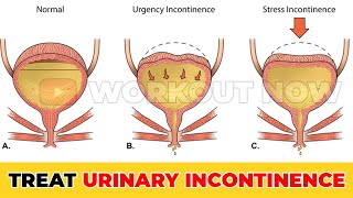 Pelvic Floor Exercises For Incontinence  Ttighten Pelvic Floor Muscles Quickly [upl. by Gen]