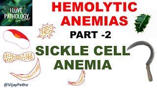 Hemolytic Anemias Part 2 SICKLE CELL ANEMIA Pathology [upl. by Livia]