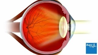 FDA reevaluates Lasik eye surgery [upl. by Aicilla960]