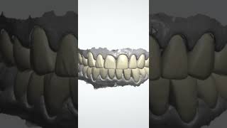 Anterior teeth Design [upl. by Akineg342]