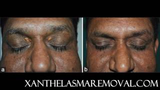 Xanthelasma removal at home without scarring the most time saving and cost effective solution [upl. by White]