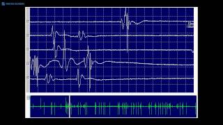 Kimura amp Kohara F32 Typical fasciculation potentials [upl. by Anial]