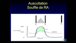 Examen physique cardio vasculaire Partie 3 [upl. by Boehike]