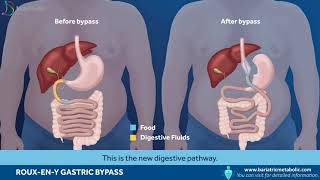 Roux EN Y Gastric Bypass [upl. by Gregoire]