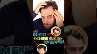 Receding Hairline regrowth derma roller hair mensgrooming [upl. by Ailel]