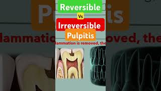 Reversible vs irreversible pulpitis [upl. by Nabal]