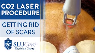 CO2 Laser Resurfacing Treatment For Getting Rid of Scars  Full Procedure [upl. by Dich]