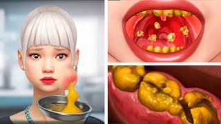 ASMR Dental Cleaning Procedures amp Tonsil Stones Removal Acne on the face  Deep Cleaning Animation [upl. by Tresa]