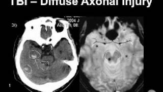 Diagnosing Brain Hemorrhages [upl. by Duvall]