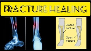 Fracture Healing  Pathology [upl. by Eiroc477]