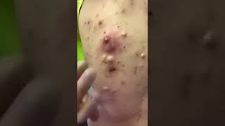 Pimples removal tiktok compilation  Extracting blackheads and whiteheads cystic acne [upl. by Elvia]