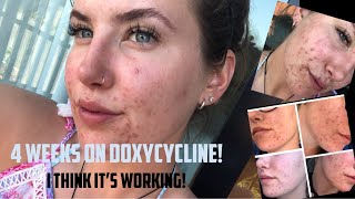 ACNE amp Doxycycline  First 4 weeks  Update [upl. by Dodds]