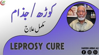 JAZAM KI BEMARI KORDH LEPROSY KA ILAJ BY HAKEEM ABBAS ALI hakeemabbasali [upl. by Euqram276]