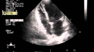 dissecting hematoma of the interventricular septum with biventricular apical small thrombi [upl. by Annaiel]