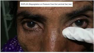 ROPLAS Regurgitation on pressure over the lacrimal sac test  ENT Lecture Series [upl. by Boehike]