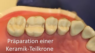 Präparation einer KeramikTeilkrone [upl. by Ilil]